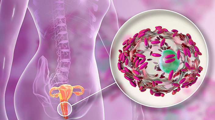 Bacterial,Vaginosis.,Vaginal,Secretions,Contain,Epithelial,Cells,,So-called,Clue,Cells
